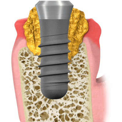 State Of Gum Disease 4 Implant